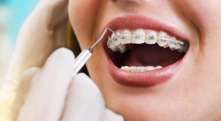 زانیاری دەربارەی ددان ڕاستکردنەوەی Orthodontic