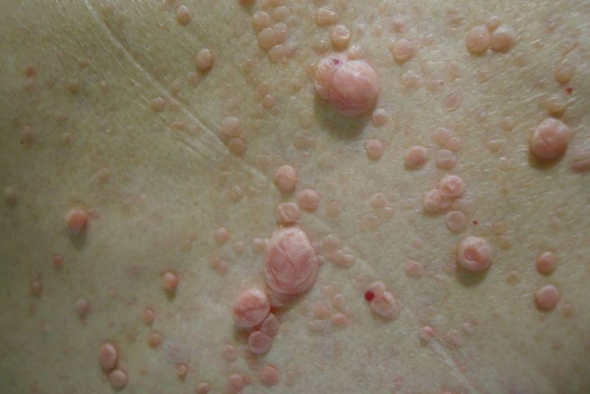 نەخۆشیی ڕیشاڵی دەمار