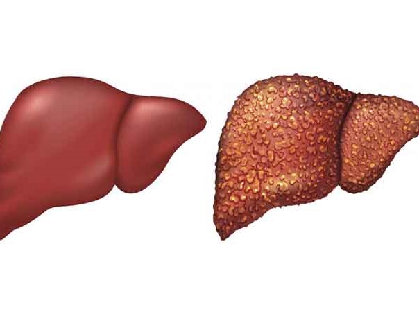 چوار نیشانە دەریدەخەن کە جگەرت تووشی کێشە بووە